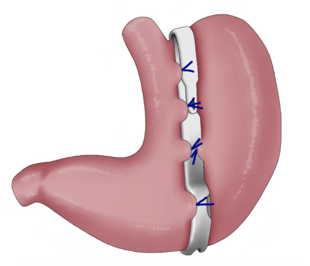 Stomach with BariClip