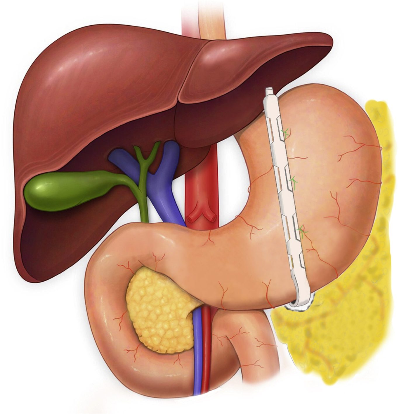 Stomach with BariClip